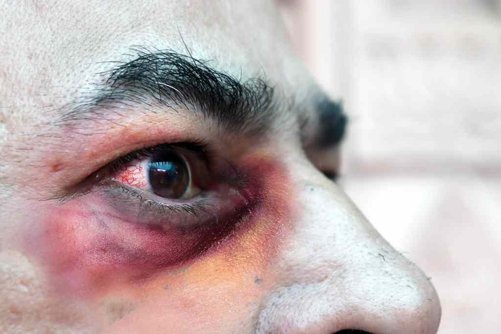 Red eye due to black fungus infection or mucormycosis infection
